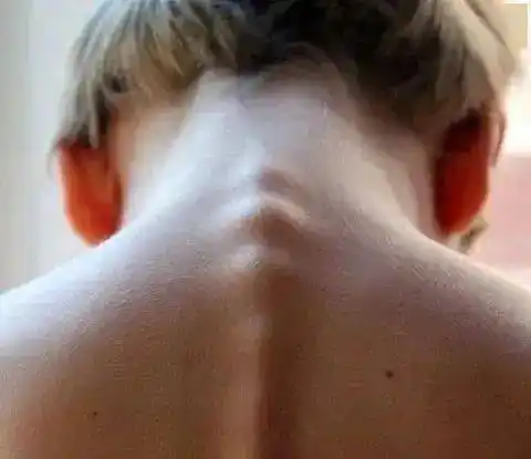 因为这个细节女孩躺上手术台80宝宝驼背和他有关