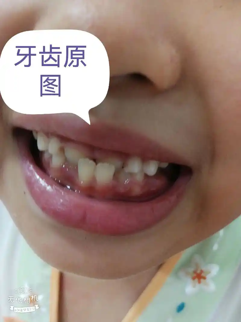 姑娘地包天坚持每天晚上佩戴每张图片都会有变化一个月的效果还是很不