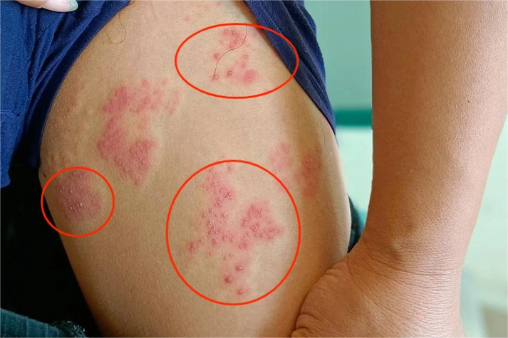 带状疱疹腿上水疱图