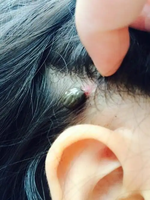 我家宝宝三岁半,被脾虫咬了,去宝鸡市人民医院把脾虫取出来了,但是过