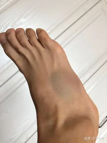 20191004右脚第五跖骨基底部骨折