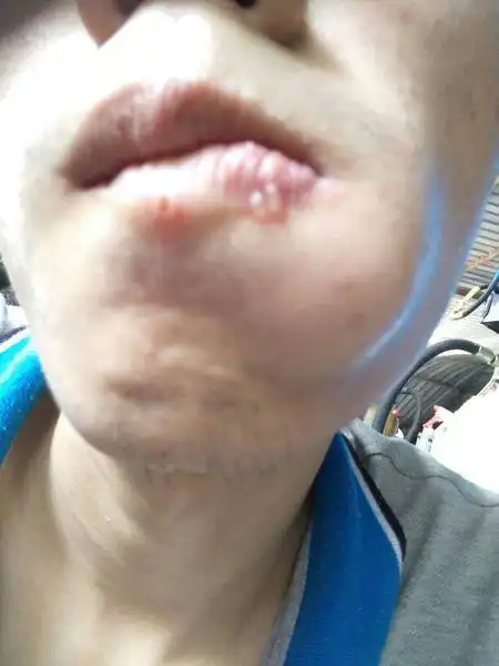 怀孕17周,嘴角长水泡,医生说是单纯性疱疹,怎么办?