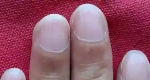 指甲长成这样,可能是癌症的信号?发生这些变化,不要忽视!