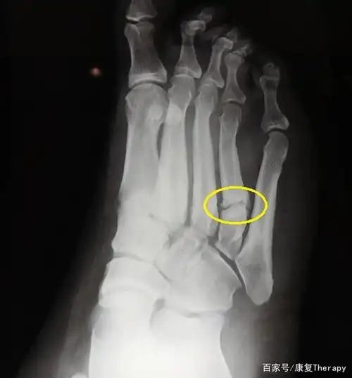 走这么多路,不怕骨折吗?医生提醒,走路脚疼要小心是骨折