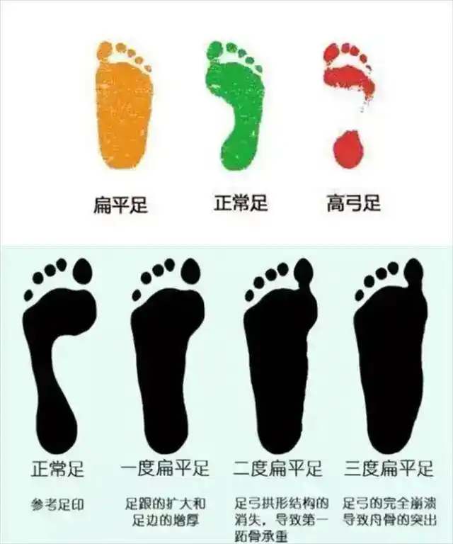 「科普」脚底平一点是正常的吗?教你如何快速判断扁平足