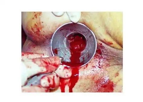 痔疮长啥样子图片_外痔疮是什么样子图片2022已更新