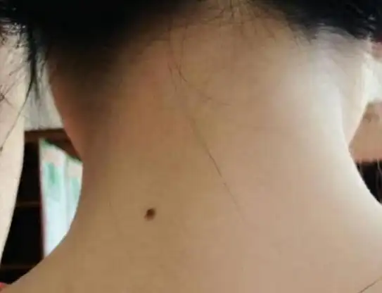 如果有,大家可以发现,很多人的脖子后面会长出黑痣,部分人在出生就有