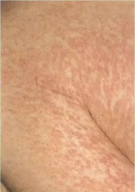 之后皮疹逐渐消退,大约3天消失,按出疹的先后顺序消退,留浅褐色色素斑