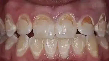 牙齿也会"脱钙"!