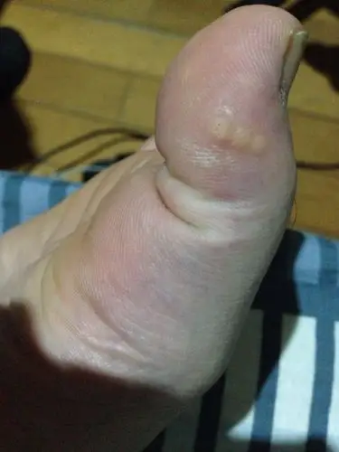 跖疣做完激光一个半月后变成水泡,一碰到就小痛.