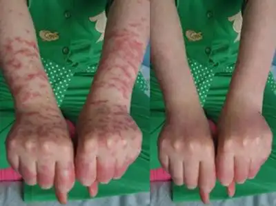 儿童红斑狼疮能活多久