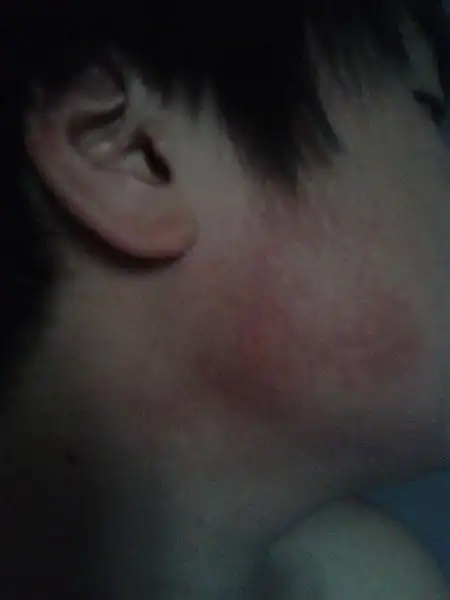 我的腮帮子两边都有大片红,请好心人告诉下怎么去除.