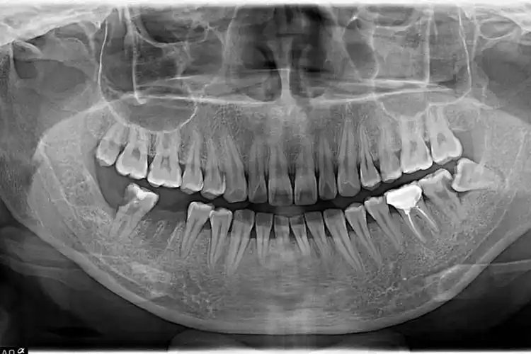 口腔全景机cbct维修