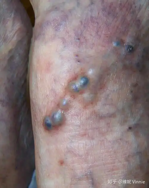 下肢浅静脉血栓是怎么回事?人们说的都很严重,有那么可怕吗?