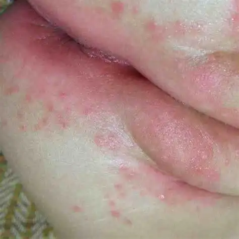 女性外唇一侧长了硬疙瘩会自愈吗