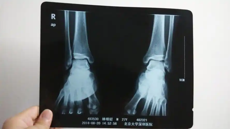 2014-07-20 于永军 医师 工伤右下胫联合分离术 韧带重建,右小腿肌肉