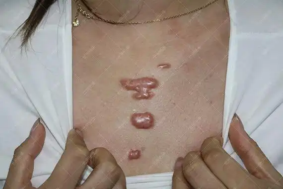 江苏韩女士前胸疤痕疙瘩治疗案例_北京疤痕医院_瘢痕修复_疤痕治疗