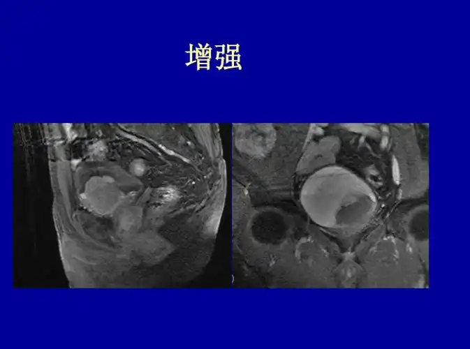 盆腔核磁共振(mri)读片基础