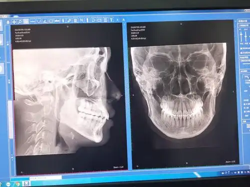朗视大视野专业口腔cbct介绍