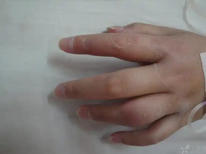 多发性蜂窝织炎?多形红斑?血管炎? - 皮肤性病 -丁香园论坛