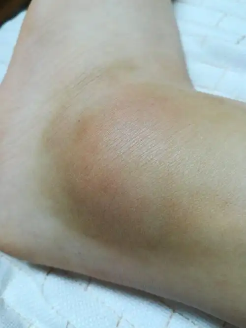 展开全部 注意疼痛,压痛点的位置,肿胀的程度,关节是否畸形.