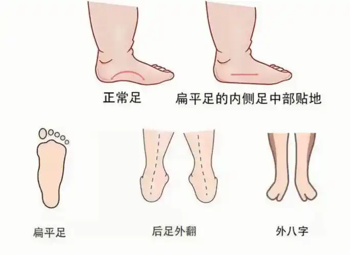 扁平足对膝盖的伤害您知道多少