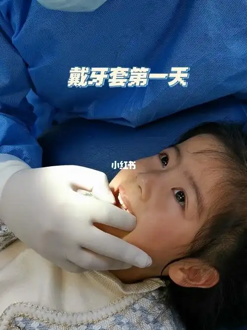 小朋友地包天戴牙套第一天