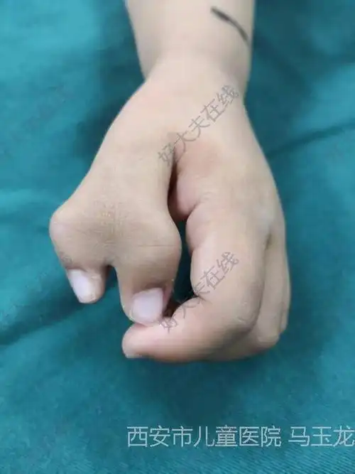右拇指多指(蟹钳指)_先天性并指多指畸形 - 好大夫在线