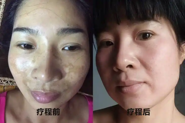 黄褐斑(蝴蝶斑)