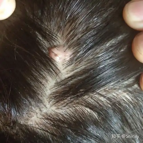 后脑勺长了一个肉疙瘩?