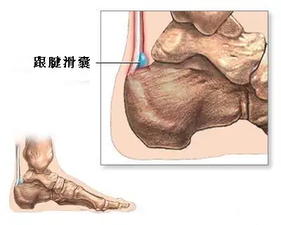 跟骨滑囊炎