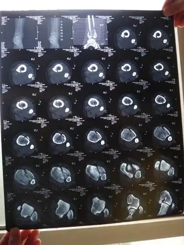 胫骨螺旋形骨折