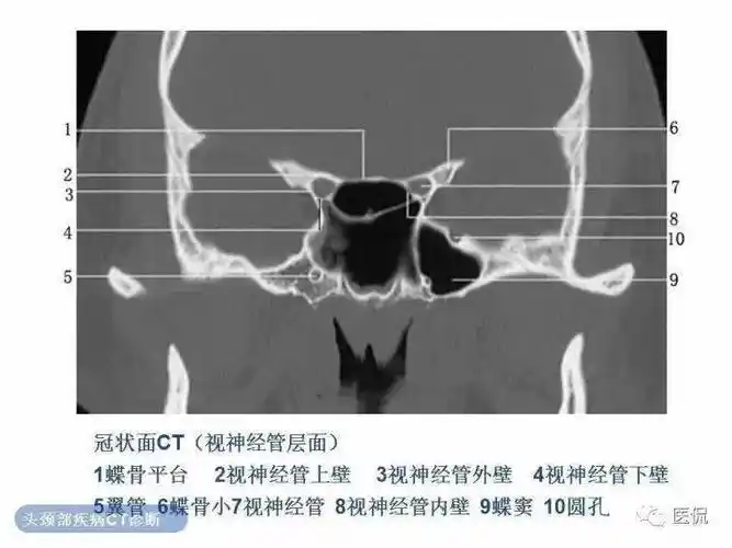 正常眼眶的ct解剖_微信