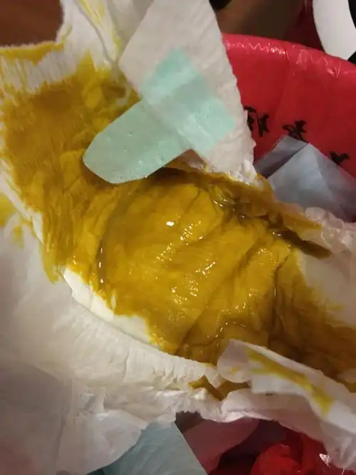 一直母乳喂养的 !大家帮我看看 要不要去医院啊 ?