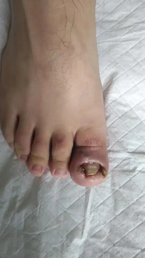 甲沟炎的保甲治疗 - 好大夫在线