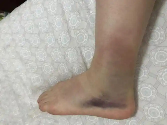 脚踝肿成馒头赛前3天才能训练辣妈吴静钰复出两个月三连冠