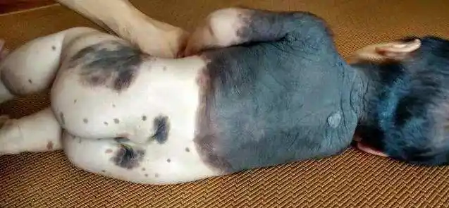 治疗先天性兽皮痣最好的方法是什么