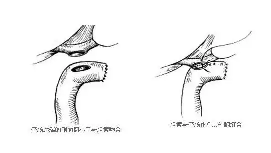 胆管空肠roux-y式吻合术-手术图解