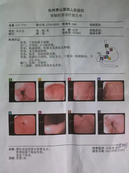 食道有异物感,有时吃过饭后特别明显,在医院做了胃镜检查说是慢性胃炎