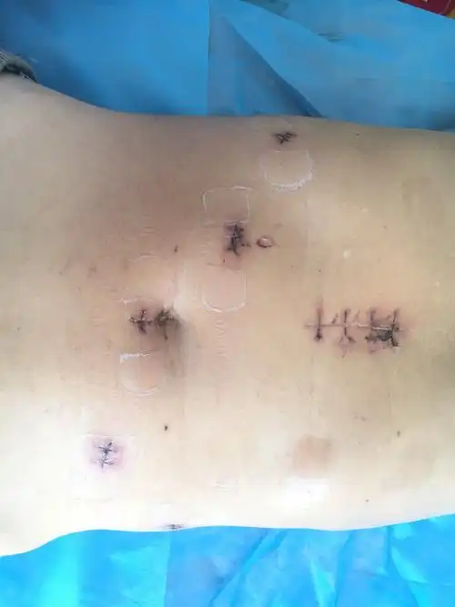 其它 首例腹腔镜脾切除术,贲门血管离断术 写美篇(比起传统手术巨大"l