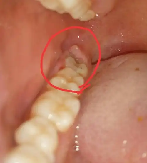 效果会更明显一些,冲出牙龈盲袋中的脓液如果智齿冠周炎经常发作,建议