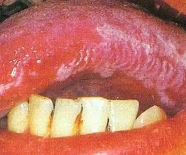 男男梅毒的早期症状图片大全