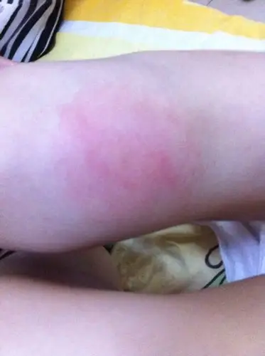 对蚊子叮咬有过敏,这是被蚊子咬后出现的大红肿,怎么办呀?