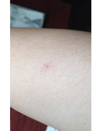 蜘蛛痣图片 (24)