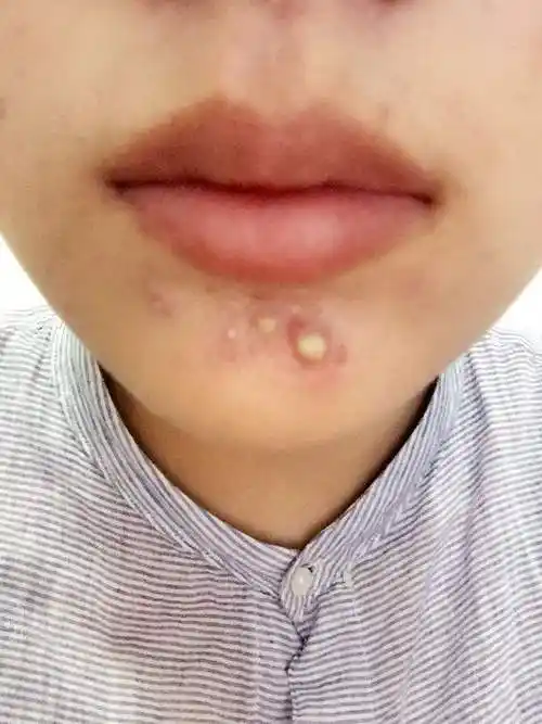 676招让你摆脱下巴的粉刺痘痘