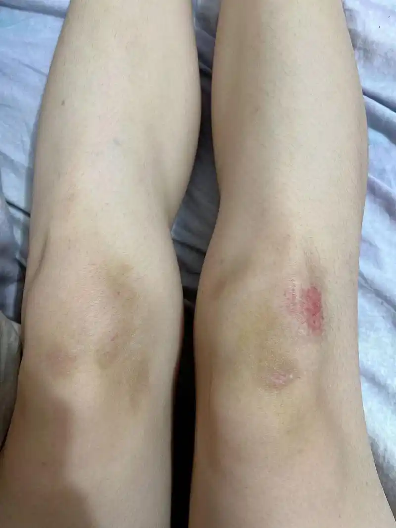 骑车摔倒擦伤的第20天(大概) 偶尔会忘记涂药