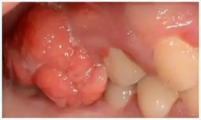 牙龈瘤科普解析