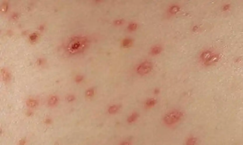 真实淋病症状皮肤自查图片 _有来医生