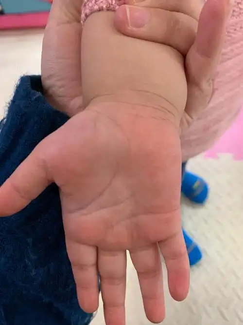 两岁手掌段纹,怎么回事?