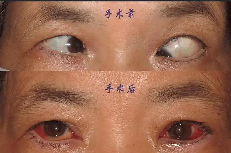 女子斜视多年不敢抬头,如今手术后终于找回自信_朱女士_进行_眼睛